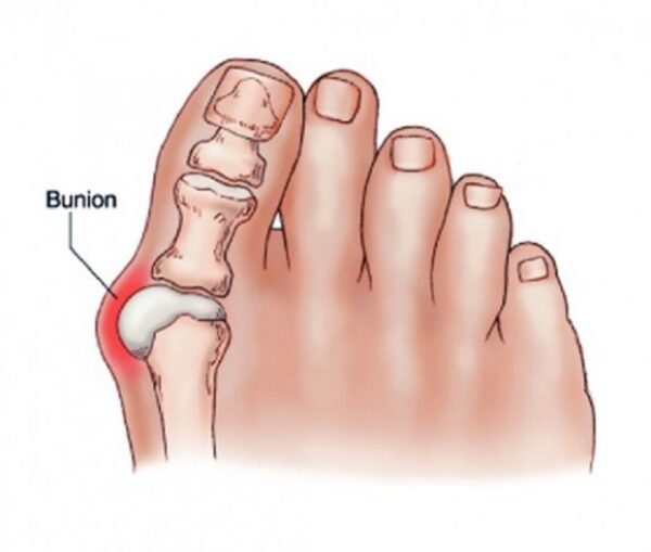 Hallux-valgus-Kalziumablagerungen. Medical Herb Lab